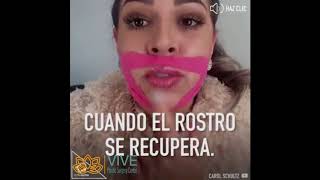 Bichectomy Tijuana Cheek Fat Pads Removal Vive Plastic Surgery [upl. by Lisk326]