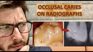 Can We Detect Occlusal Caries on Radiographs Bitewing x ray  caries removal icdas classification [upl. by Nonac729]