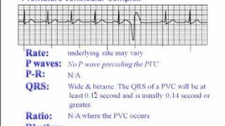 ECG Premature Ventricular Complexes PVC [upl. by Oalsinatse]