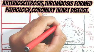 ArteriosclerosisThrombosis Formed PathologyCoronary Heart Disease umerfarooqbiology7083 [upl. by Aisemaj]