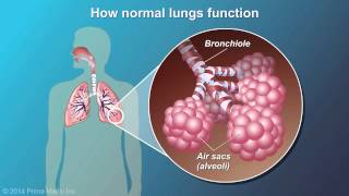 Understanding COPD [upl. by Nnahgaem]