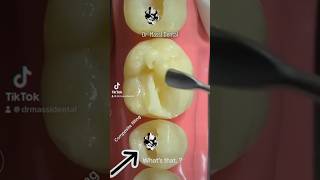 Composite Filling or Amalgam [upl. by Otes]