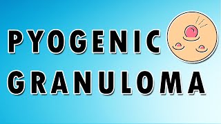 Pyogenic Granuloma Symptoms Treatment and Causes [upl. by Clercq]