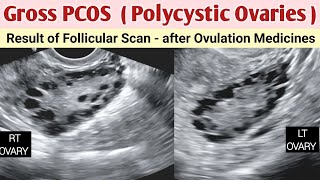 PCOS  TVS Ultrasound Gross Polycystic Ovaries  Infertility  PCOD [upl. by Latsyk]