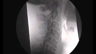 Video Fluoroscopy  Cervical Spine  SMVFRFC71712wmv [upl. by Ahsiaa]