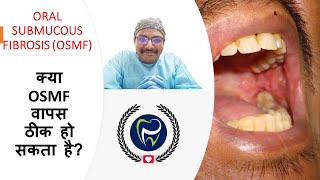 Dr Rudra Mohan  is OSMF reversible  क्या OSMF वापस ठीक हो सकता है Oral Submucous Fibrosis [upl. by Aifoz]