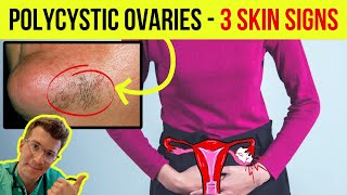 Doctor explains 3 SKIN SIGNS ASSOCIATED WITH POLYCYSTIC OVARIAN SYNDROME PCOS [upl. by Audres]