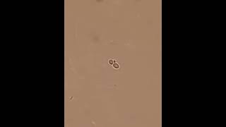 Yeast cells Candidiasis Monilia in the urine [upl. by Niram]