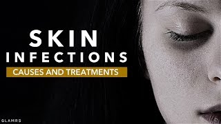 Skin Infections Causes And Treatments [upl. by Emelyne]