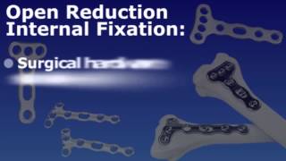 Wrist Fracture  Open Reduction and Internal or External Fixation [upl. by Inwat]