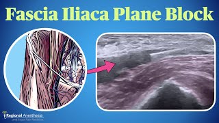 Fascia Iliaca Plane Block [upl. by Eojyllib]