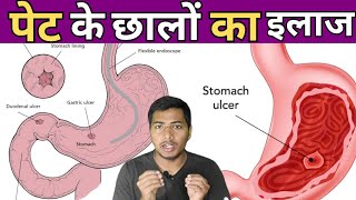 ulcer क्या होते हैं या पेट मैं छाले क्यों होते हैंclinic pharmacy mbbs hospital nursingpharma [upl. by Kcirevam]