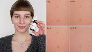 The Ordinary Ascorbic Acid 8  Alpha Arbutin 2 Dark Spots  Before amp After 13 Weeks Acne Marks [upl. by Boleslaw93]