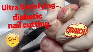 Diabetic Nail Cutting and Grinding [upl. by Karoline]