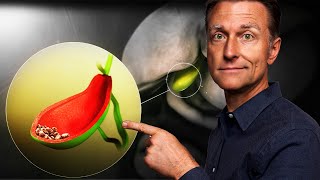 Gallbladder Removal Surgery  Vital Things to Know MUST WATCH [upl. by Mandy382]