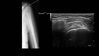 Ultrasound guided subacromial steroid injection calcific tendinitis and bursitis [upl. by Handal]