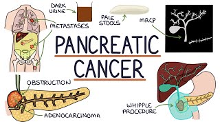 Understanding Pancreatic Cancer [upl. by Euqenimod]