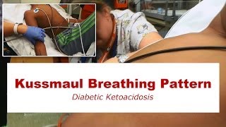 Kussmaul Breathing Pattern [upl. by Amada77]