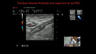 Trombosi Venosa Profonda da PICC al braccio destro [upl. by Vail470]