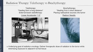 No Beam Required InsideOut Radiotherapy HDR Brachytherapy for Prostate Cancer [upl. by Olvan495]