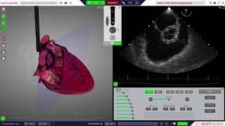 HeartWorks Right coronary artery regional wall motion abnormality [upl. by Yraillih]