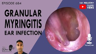 684  Granular Myringitis Ear Infection [upl. by Naegem]