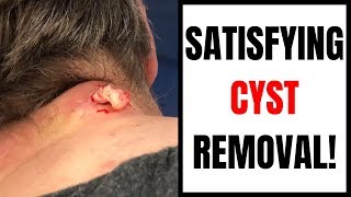 SATISFYING CYST REMOVAL [upl. by Eive]