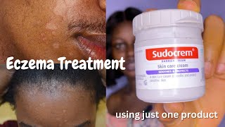 Eczema Treatment  How to Get Rid of Eczema using Sudocrem [upl. by Deer864]