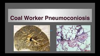 Pneumoconiosis Coal workers pneumoconiosis [upl. by Salim]