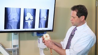 Partial Knee Replacement  A Total Solution for a Partial Problem [upl. by Fein]