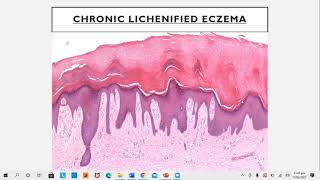 Lecture78 Eczematous disorders PartI Rooks chapter 39 [upl. by Roath20]