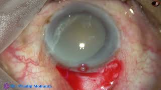 SICS for a Hypermature Morgagnian cataract  Pradip Mohanta 23rd April 2022 [upl. by Quartas594]