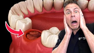 Is This Wisdom Teeth Removal Myth BUSTED [upl. by Aunson431]