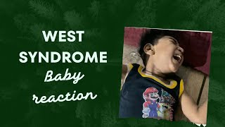 west syndrome seizure west syndrome kya hota hai in hindi west syndrome infantile spasms [upl. by Annoel]