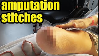 Amputation Recovery Incision amp Stitches [upl. by Nileuqay378]