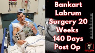 Bankart Labrum Surgery 20 weeks 140 days Post Op [upl. by Neelcaj]