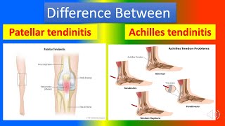 Difference Between Patellar tendinitis and Achilles tendinitis [upl. by Saville]