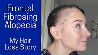 Frontal Fibrosing Alopecia  My Symptoms Diagnosis Treatments [upl. by Arfihs]