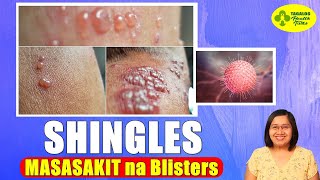 MASAKIT na Blisters Dulot ng SHINGLES  Varicella Zoster Virus  Tagalog Health Tips  Nurse Dianne [upl. by Moreta]