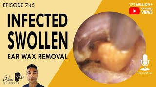 745  Infected Swollen Ear Wax Removal [upl. by Laurance513]