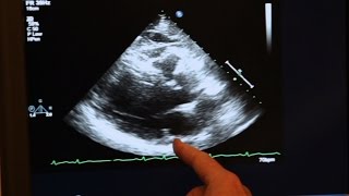 Echocardiogram Demonstration [upl. by Chavez]