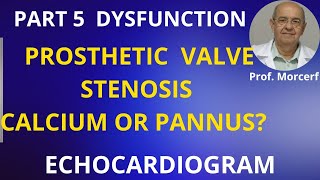 Warning Understanding Calcium vs Pannus [upl. by Einal]