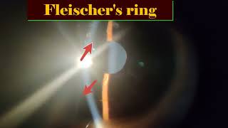 Fleischers ring and Vogts striae keratoconus cornea eyedoc ophthalmology [upl. by Yrallam]