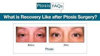 What is Recovery Like after Ptosis Surgery When Performed by Oculoplastic Surgeon Dr Amiya Prasad [upl. by Oicaroh]