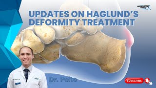 Updates on Haglunds deformity treatment [upl. by Aidni]