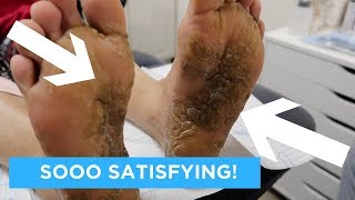 EXTREMELY SATISFYING AND RELAXING CALLUS CARE [upl. by Eittah151]