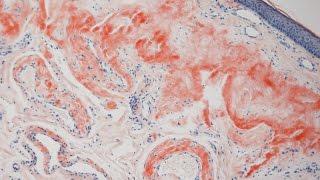 What is Amyloid  Pathology mini tutorial [upl. by Adnaral]