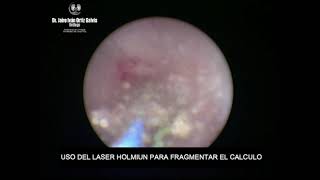 LITOTRICIA LASER EN CALCULO URETERAL DERECHO 2 [upl. by Rramal]