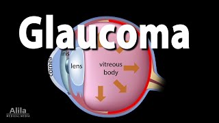 Development of Glaucoma Animation Open Angle vs Angle Closure Glaucoma [upl. by Mayap351]