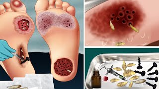 ASMR Treatment infected parasitic wounds and remove snails disinfect the soles of the feet [upl. by Nosreme880]